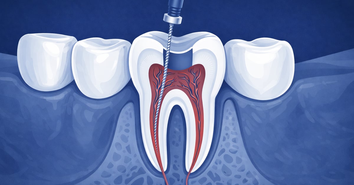 Endodontics in Reno, NV | Silverado Family Dentistry